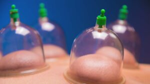 a patient receiving cupping therapy