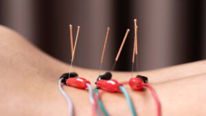 Pittsburgh Osteopractic administering electro dry needling treatments