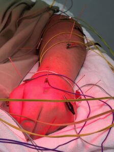 electro,acupuncture,therapy,on,the,hand,with,wires,around